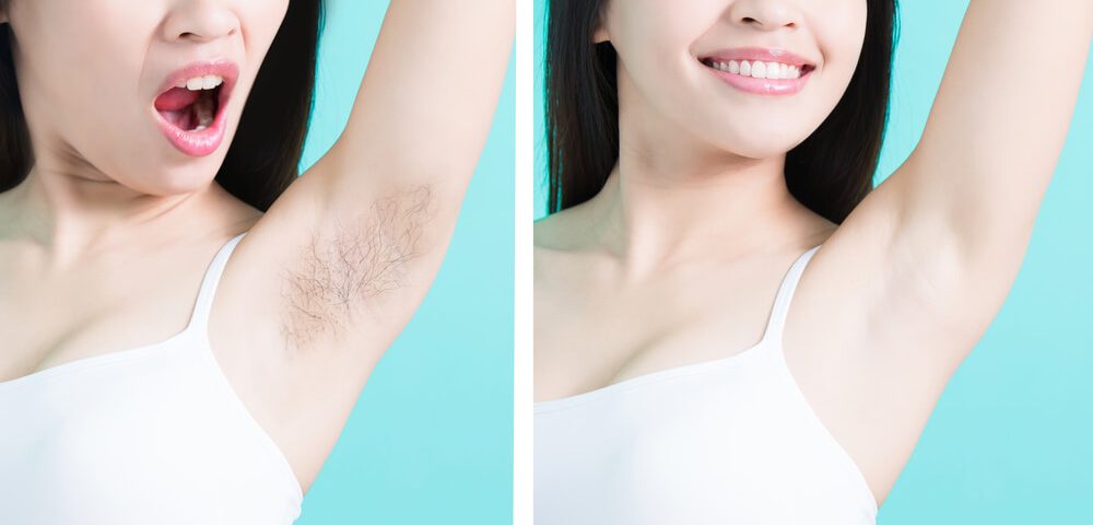 Laser Hair Removal Before And After