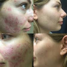 carbon laser peel carbon laser peel